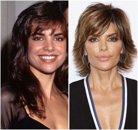 what happened to lisa rinna's lips
